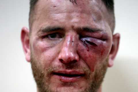 Bare-knuckle boxer Nathan Decastro looks unrecognisable after taking brutal beating as he shows off gruesome eye injury