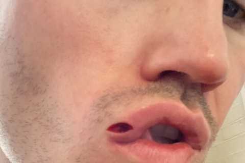 Shane McGuigan shows off gruesome split lip which requires stitches after being punched in face by Daniel Dubois