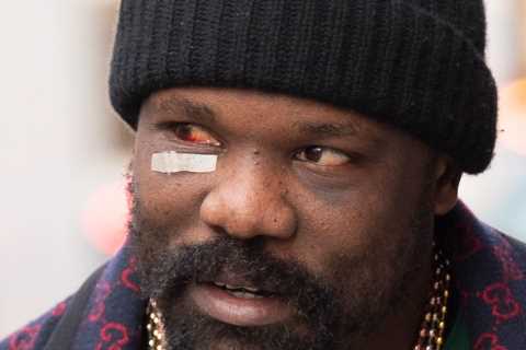 Derek Chisora shows off gruesome-looking eye injury after Tyson Fury defeat as he shops for scented candles with manager