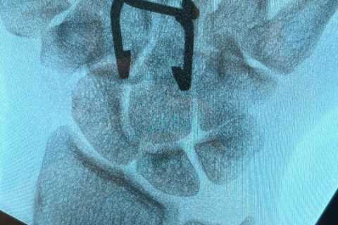 Ebanie Bridges shares gruesome pictures of her hand surgery after breaking bone in build-up to Shannon O’Connell fight