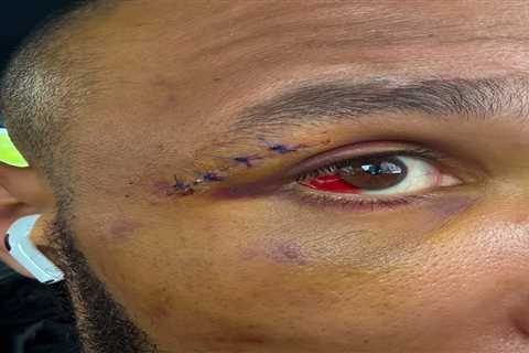 Eubank Jr. flashes mangled eye on Netflix set after dad claims he nearly died in Benn bloodbath